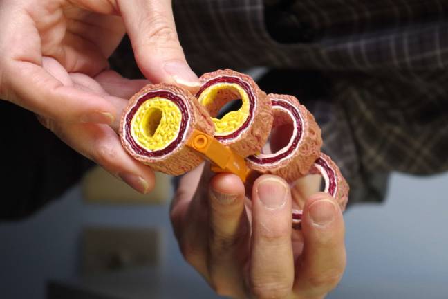 Unique specialty comes to Vernon A detailed close-up view of a device that Dr. Blair Beltzer uses to show the early and advanced stages of cardiovascular disease and atherosclerosis in an artery.