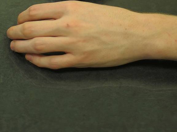 A recovering heroin addict, alias: "Ben," shows his hand. Ben is now in his mid twenties he used the drug for roughly ten years.